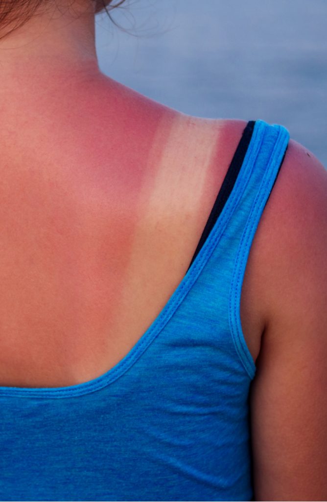 sunburn | ways to soothe a sunburn | sunburn tips | sunburn tricks | tips and tricks | summer | summer hacks | sunburn hacks 