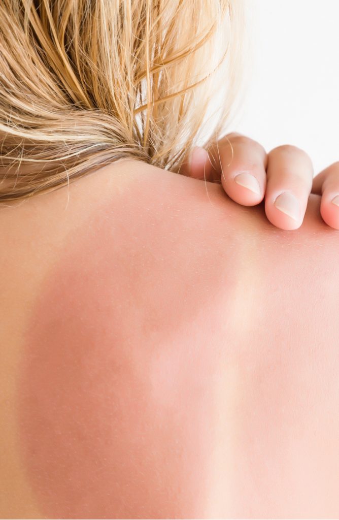 sunburn | ways to soothe a sunburn | sunburn tips | sunburn tricks | tips and tricks | summer | summer hacks | sunburn hacks 